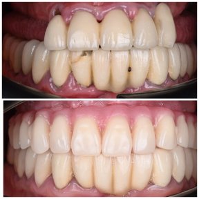 Before and after All-on-4 dental implants result at YAREMA DENTAL – full smile restoration