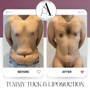before-after photo abdominoplasty