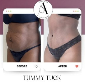 before-after photo abdominoplasty