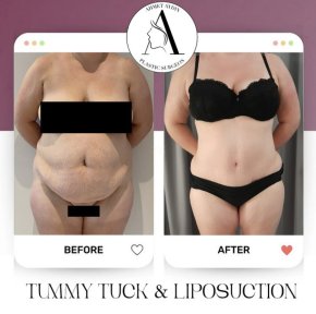 before-after photo abdominoplasty
