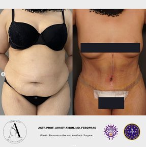 before-after photo abdominoplasty