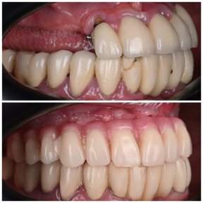 Before and after All-on-4 dental implants result at YAREMA DENTAL – full smile restoration