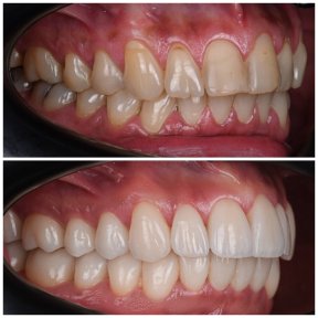 Before and after veneers at YAREMA DENTAL – smile transformation with natural-looking results