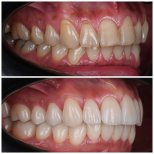 Before and after veneers at YAREMA DENTAL – smile transformation with natural-looking results