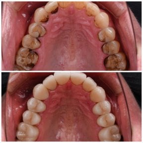 Before and after veneers at YAREMA DENTAL – restored upper teeth with natural-looking results