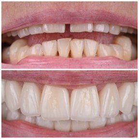 Before and after dental veneers at YAREMA DENTAL – smile makeover with natural-looking results