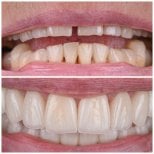 Before and after dental veneers at YAREMA DENTAL – smile makeover with natural-looking results