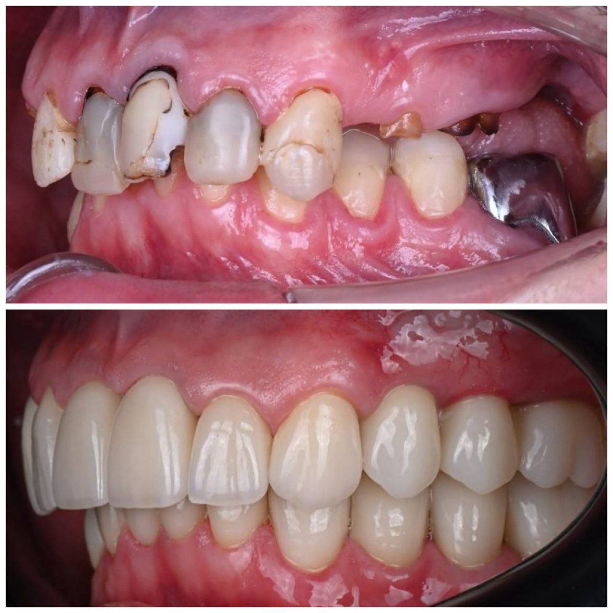 Resultados antes y después de implantes dentales en YAREMA DENTAL: sonrisa restaurada