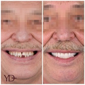 Before and after dental implant results at YAREMA DENTAL – restored smile and missing teeth