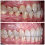 Before and after braces results at YAREMA DENTAL – improved teeth alignment and smile
