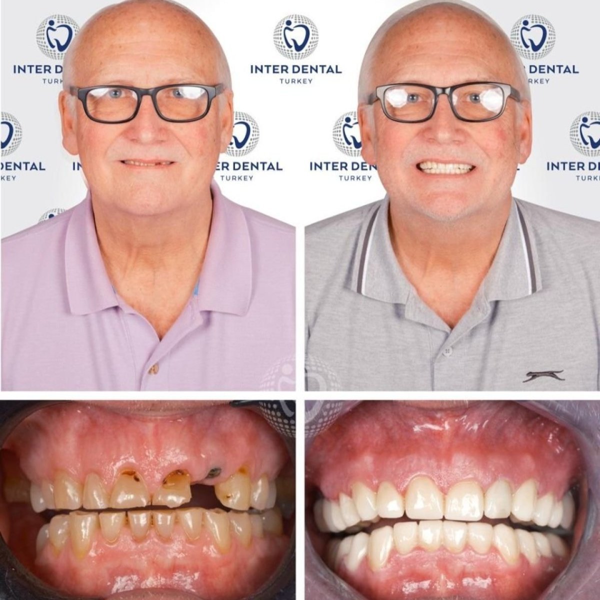 Resultados de implantes dentales antes y después en Inter Dental Turkey: sonrisa restaurada
