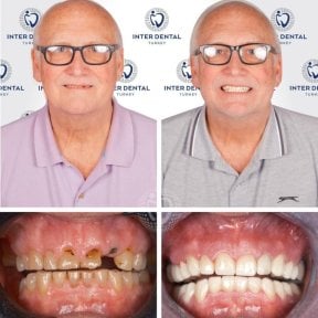 before-after photo dental-implant