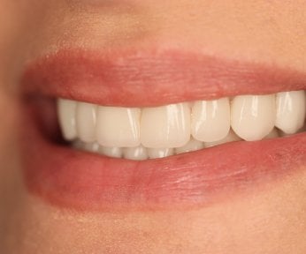 Veneers smile makeover result at Skhva Clinic – bright, natural-looking teeth transformation
