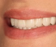 Veneers smile makeover result at Skhva Clinic – bright, natural-looking teeth transformation