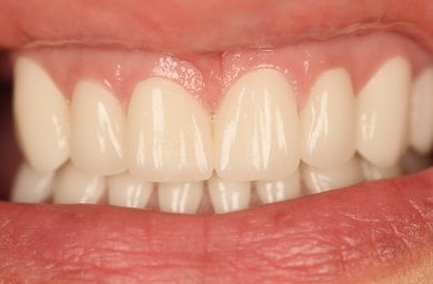 Veneers result at Skhva Clinic – bright, natural-looking smile after dental treatment