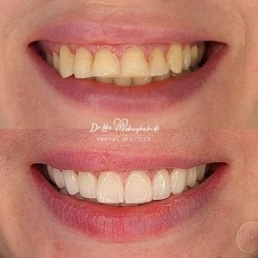 Before and after dental implant results at Skhva Clinic – improved smile and whiter teeth