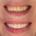 Before and after dental implant results at Skhva Clinic – improved smile and whiter teeth
