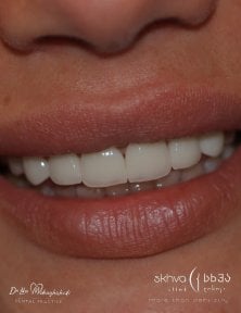 نتيجة زراعة الأسنان في Skhva Clinic – ابتسامة طبيعية مستعادة بعد الإجراء