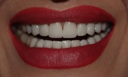 Dental implant result at Skhva Clinic – restored smile with natural-looking teeth