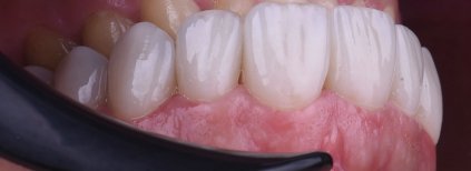 Efekt implantu zęba w Dentaland Premium Luxury Clinic & Academy, naturalny uśmiech