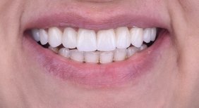 Efekt implantu zęba w Dentaland Premium Luxury Clinic & Academy, przywrócony naturalny uśmiech