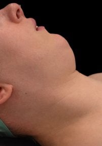 До установки скуловых имплантов в Klinika Promedion, вид сбоку, естественный контур