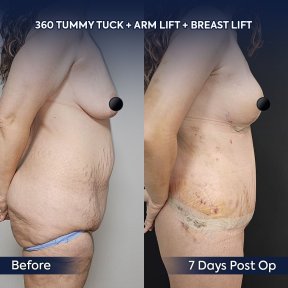 Before and after arm lift, tummy tuck, breast lift results at Dr. Safa Manav Clinic