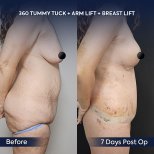 Before and after arm lift, tummy tuck, breast lift results at Dr. Safa Manav Clinic