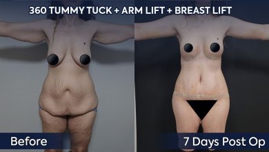 Arm lift, tummy tuck, and breast lift before and after results at Dr. Safa Manav Clinic