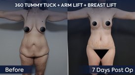 Arm lift, tummy tuck, and breast lift before and after results at Dr. Safa Manav Clinic
