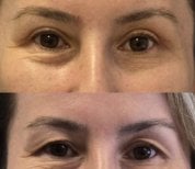 Before and after Lower Eyelid Blepharoplasty photos by Dr. 