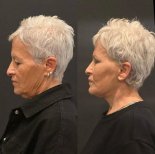 Efekty przed i po liftingu czoła w Turan Turan Health Group, widoczna redukcja zmarszczek