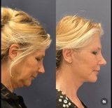 Foto prima e dopo di Lifting della fronte realizzate dal Dott./Dott.ssa 
