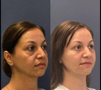 Forehead lift before and after results at Turan Turan Health Group, smoother forehead appearance