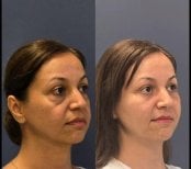 Forehead lift before and after results at Turan Turan Health Group, smoother forehead appearance