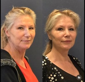 Forehead lift before and after results at Turan Turan Health Group, visible rejuvenation effect