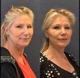 Forehead lift before and after results at Turan Turan Health Group, visible rejuvenation effect