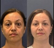 Foto prima e dopo di Lifting della fronte realizzate dal Dott./Dott.ssa 