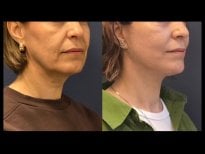 Foto prima e dopo di Liposuzione del collo realizzate dal Dott./Dott.ssa 