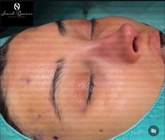 Rhinoplasty result at Semih Oztuna Plastic Surgery – reshaped nose with natural appearance