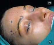 Foto prima e dopo di Liposuzione del collo realizzate dal Dott./Dott.ssa 