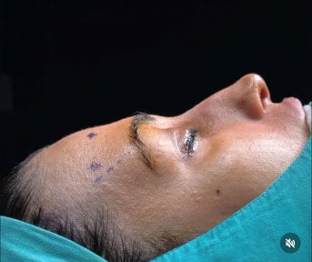 Neck liposuction procedure at Turan Turan Health Group, patient prepared for surgery