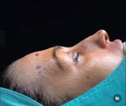 Neck liposuction procedure at Turan Turan Health Group, patient prepared for surgery