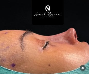 Rhinoplasty result at Semih Özçınar Plastic Surgery – improved nose profile after surgery