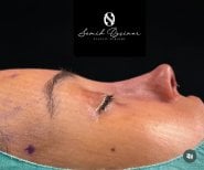 Rhinoplasty result at Semih Özçınar Plastic Surgery – improved nose profile after surgery