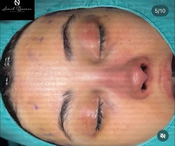نتيجة عملية تجميل الأنف في Semih Deviren Plastic Surgery بعد إعادة تشكيل الأنف