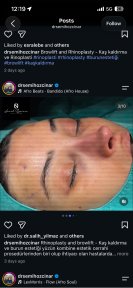 نتيجة رفع الحاجب وتجميل الأنف في Turan Turan Health Group، تحسين شكل الحاجب والأنف