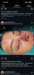 نتيجة رفع الحاجب وتجميل الأنف في Turan Turan Health Group، تحسين شكل الحاجب والأنف