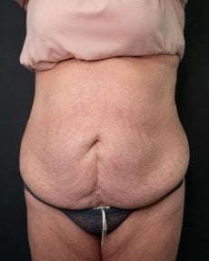 before-after photo abdominoplastika