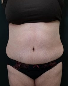 before-after photo abdominoplastika